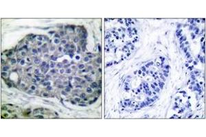 Immunohistochemistry analysis of paraffin-embedded human breast carcinoma, using Acetyl-CoA Carboxylase (Phospho-Ser80) Antibody. (Acetyl-CoA Carboxylase anticorps  (pSer80))