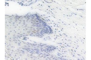Phospho-PHB2 (Ser39) Antibody at 1/100 staining human cervical carcinoma by IHC-P. (Prohibitin 2 anticorps  (pSer39))