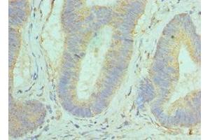 Immunohistochemistry of paraffin-embedded human colon cancer using ABIN7154290 at dilution of 1:100 (GOLM1 anticorps  (AA 112-401))
