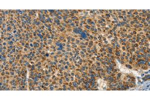 Immunohistochemistry of paraffin-embedded Human liver cancer tissue using IFT74 Polyclonal Antibody at dilution 1:60 (IFT74 anticorps)
