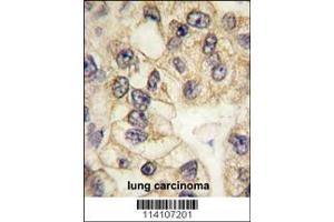Formalin-fixed and paraffin-embedded human lung carcinoma tissue reacted with CD14 antibody (C-term), which was peroxidase-conjugated to the secondary antibody, followed by DAB staining. (CD14 anticorps  (C-Term))