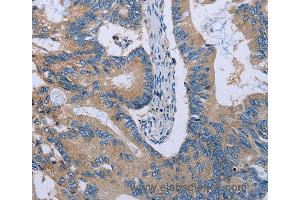 Immunohistochemistry of Human colon cancer using HYAL3 Polyclonal Antibody at dilution of 1:40 (HYAL3 anticorps)
