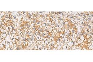 Immunohistochemistry of paraffin-embedded Human liver cancer tissue using PTPRN Polyclonal Antibody at dilution of 1:55(x200) (PTPRN anticorps)