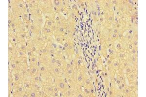 Immunohistochemistry of paraffin-embedded human liver cancer using ABIN7155713 at dilution of 1:100 (HOXA2 anticorps  (AA 26-124))