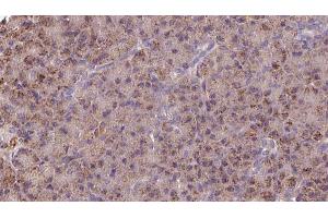 ABIN6273252 at 1/100 staining Human pancreas cancer tissue by IHC-P. (GSTM3 anticorps  (C-Term))
