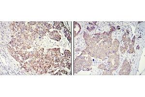 Immunohistochemical analysis of paraffin-embedded galactophore tumour using ERBB2 mouse mAb with DAB staining