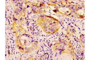 IHC image of ABIN7154907 diluted at 1:300 and staining in paraffin-embedded human cervical cancer performed on a Leica BondTM system. (HSP27 anticorps  (AA 108-205))