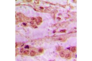 Immunohistochemical analysis of API5 staining in human lung cancer formalin fixed paraffin embedded tissue section. (Apoptosis Inhibitor 5 anticorps  (C-Term))