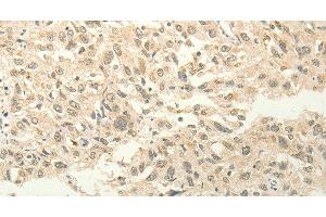 Immunohistochemistry of paraffin-embedded Human esophagus cancer tissue using FZD8 Polyclonal Antibody at dilution 1:50 (FZD8 anticorps)