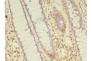Immunohistochemistry of paraffin-embedded human colon cancer using ABIN7164329 at dilution of 1:100