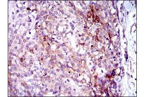 Immunohistochemical analysis of paraffin-embedded esophagus cancer tissues using GPNMB mouse mAb with DAB staining.