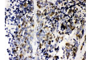Anti- Cyclin A2 Picoband antibody, IHC(P) IHC(P): Human Lung Cancer Tissue (Cyclin A anticorps  (AA 10-168))