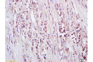 Formalin-fixed and paraffin embedded human lung carcinoma labeled with Anti-GTSE-1 Polyclonal Antibody, Unconjugated (ABIN741405) at 1:200, followed by conjugation to the secondary antibody and DAB staining (GTSE1 anticorps  (AA 651-739))