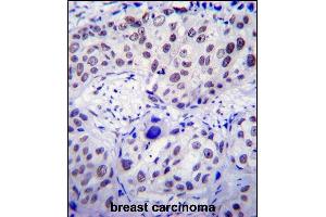 USF1 Antibody (Center) (ABIN655030 and ABIN2844661) immunohistochemistry analysis in formalin fixed and paraffin embedded human breast carcinoma followed by peroxidase conjugation of the secondary antibody and DAB staining.