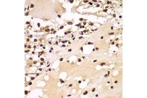 Immunohistochemistry of paraffin-embedded human kidney cancer using ZNF20 antibody  at dilution of 1:100 (40x lens).