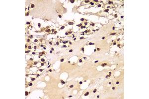 Immunohistochemistry of paraffin-embedded human kidney cancer using ZNF20 antibody  at dilution of 1:100 (40x lens). (ZNF20 anticorps  (AA 1-200))