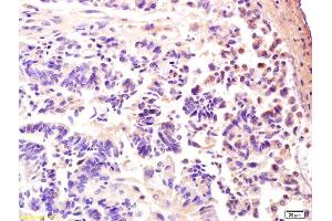 Formalin-fixed and paraffin embedded human rectal carcinoma labeled with Anti-AMPK gamma 3/PRKAG3 Polyclonal Antibody, Unconjugated (ABIN751873) at 1:200 followed by conjugation to the secondary antibody and DAB staining.