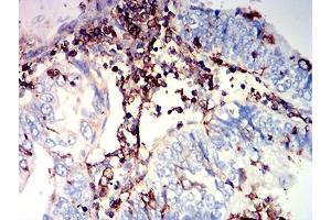 Immunohistochemical analysis of paraffin-embedded endometrial cancer tissues using CD97 mouse mAb with DAB staining. (CD97 anticorps  (AA 419-552))