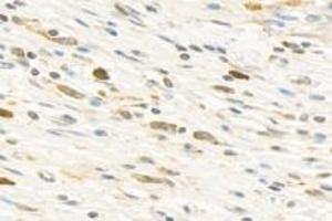 Immunohistochemistry analysis of paraffin-embedded human stomach cancer using PARP1 (ABIN7075114) at dilution of 1: 750