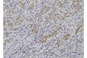 ABIN6274254 at 1/100 staining Human lung cancer tissue by IHC-P. (NBL1 anticorps  (C-Term))