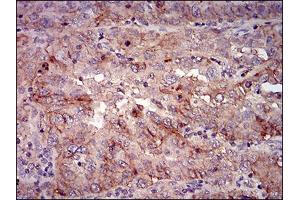 Immunohistochemical analysis of paraffin-embedded endometrial cancer tissues using mSplunc2 mouse mAb with DAB staining.