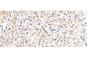 Immunohistochemistry of paraffin-embedded Human prost ate cancer tissue using HLA-DOB Polyclonal Antibody at dilution of 1:40(x200) (HLA-DOB anticorps)