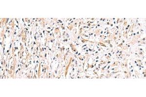 Immunohistochemistry of paraffin-embedded Human prost ate cancer tissue using HLA-DOB Polyclonal Antibody at dilution of 1:40(x200) (HLA-DOB anticorps)