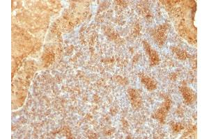 Formalin-fixed, paraffin-embedded human Salivary Tumor stained with Cytochrome C Monoclonal Antibody (SPM389).