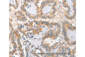 Immunohistochemistry of Human thyroid cancer using ALPP Polyclonal Antibody at dilution of 1:60 (PLAP anticorps)