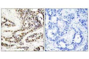 Immunohistochemical analysis of paraffin-embedded human breast carcinoma tissue using CREB(Phospho-Ser129) Antibody(left) or the same antibody preincubated with blocking peptide(right).
