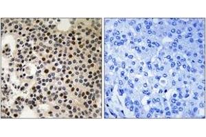 Immunohistochemistry analysis of paraffin-embedded human breast carcinoma, using PAK2 (Phospho-Ser197) Antibody. (PAK2 anticorps  (pSer197))