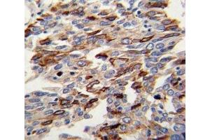 IHC analysis of FFPE human lung carcinoma with CD31 antibody