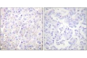 Immunohistochemistry analysis of paraffin-embedded human breast carcinoma tissue, using Cadherin-pan Antibody. (Cadherin anticorps  (AA 833-882))