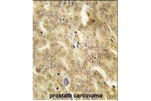 Formalin-fixed and paraffin-embedded human prostata carcinoma tissue reacted with HSP40 Antibody (ABIN1882092 and ABIN2846365) , which was peroxidase-conjugated to the secondary antibody, followed by DAB staining. (DNAJB1 anticorps)