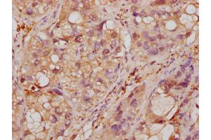 IHC image of ABIN7143869 diluted at 1:500 and staining in paraffin-embedded human liver cancer tissue performed on a Leica BondTM system.