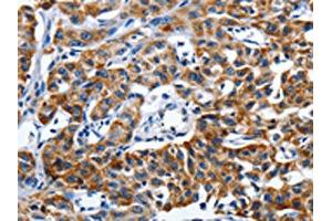 The image on the left is immunohistochemistry of paraffin-embedded Human lung cancer tissue using ABIN7191255(LAMA1 Antibody) at dilution 1/25, on the right is treated with synthetic peptide. (Laminin alpha 1 anticorps)