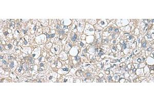 Immunohistochemistry of paraffin-embedded Human liver cancer tissue using RHBDL2 Polyclonal Antibody at dilution of 1:110(x200) (RHBDL2 anticorps)