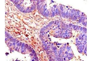 Immunohistochemistry of paraffin-embedded human ovarian cancer using ABIN7158853 at dilution of 1:100 (CDC25B anticorps  (AA 1-195))