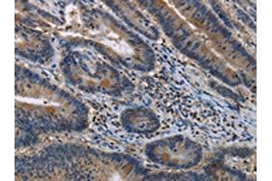 The image on the left is immunohistochemistry of paraffin-embedded Human colon cancer tissue using ABIN7191144(ITPR2 Antibody) at dilution 1/40, on the right is treated with synthetic peptide. (ITPR2 anticorps)