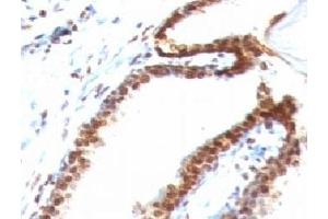 Formalin-fixed, paraffin-embedded human colon carcinoma stained with Double Stranded DNA antibody (DSD/958) (dsDNA anticorps)