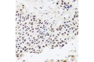 Immunohistochemistry of paraffin-embedded human lung cancer using RPP30 antibody at dilution of 1:100 (x40 lens).