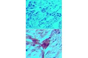 Immunohistochemical analysis of ARHGDIB monoclonal antibody, clone 97A1015  in formalin-fixed, paraffin-embedded human breast tumor tissue using an isotype control (top) and ARHGDIB monoclonal antibody, clone 97A1015  (bottom) at 5 ug/mL . (ARHGDIB anticorps  (Cleavage Site))