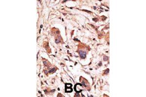 Formalin-fixed and paraffin-embedded human cancer tissue reacted with MAGED1 polyclonal antibody  , which was peroxidase-conjugated to the secondary antibody, followed by DAB staining. (MAGED1 anticorps  (Internal Region))