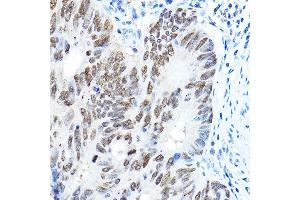 Immunohistochemistry of paraffin-embedded human colon carcinoma using FOX Rabbit pAb (5278) at dilution of 1:100 (40x lens). (FOXA1 anticorps  (AA 263-472))