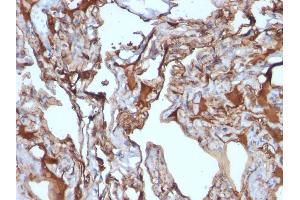 Formalin-fixed, paraffin-embedded human Melanoma stained with MUC18 Mouse Monoclonal Antibody (MUC18/1130). (MCAM anticorps)