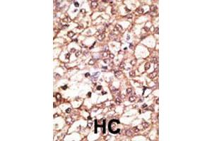 Formalin-fixed and paraffin-embedded human hepatocellular carcinoma tissue reacted with KREMEN1 polyclonal antibody , which was peroxidase-conjugated to the secondary antibody, followed by AEC staining. (KREMEN1 anticorps  (N-Term))