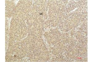 Immunohistochemical analysis of paraffin-embedded Human Kidney Carcinoma Tissue using SGK1 Mouse mAb diluted at 1:200.