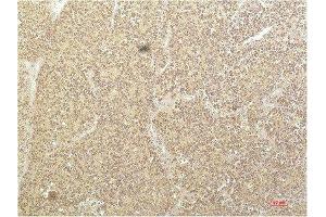 Immunohistochemical analysis of paraffin-embedded Human Kidney Carcinoma Tissue using SGK1 Mouse mAb diluted at 1:200. (SGK1 anticorps  (AA 350-430))