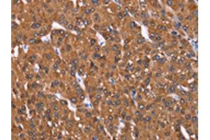 The image on the left is immunohistochemistry of paraffin-embedded Human liver cancer tissue using ABIN7191000(HRASLS2 Antibody) at dilution 1/40, on the right is treated with synthetic peptide. (HRASLS2 anticorps)