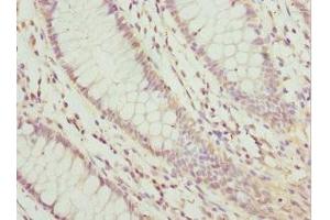 Immunohistochemistry of paraffin-embedded human colon cancer using ABIN7157970 at dilution of 1: 100 (LEFTY2 anticorps  (AA 57-366))